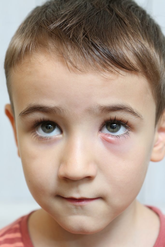 A child with a chalazion