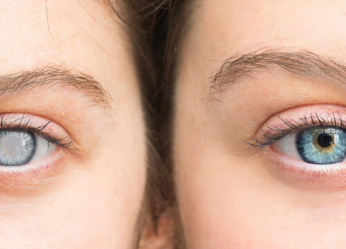 Cataract pupil vs healthy pupil side-by-side